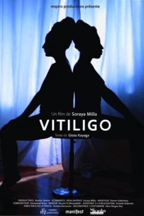 Vitiligo